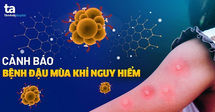 Chủng virus đậu mùa khỉ có 47 đột biến mới