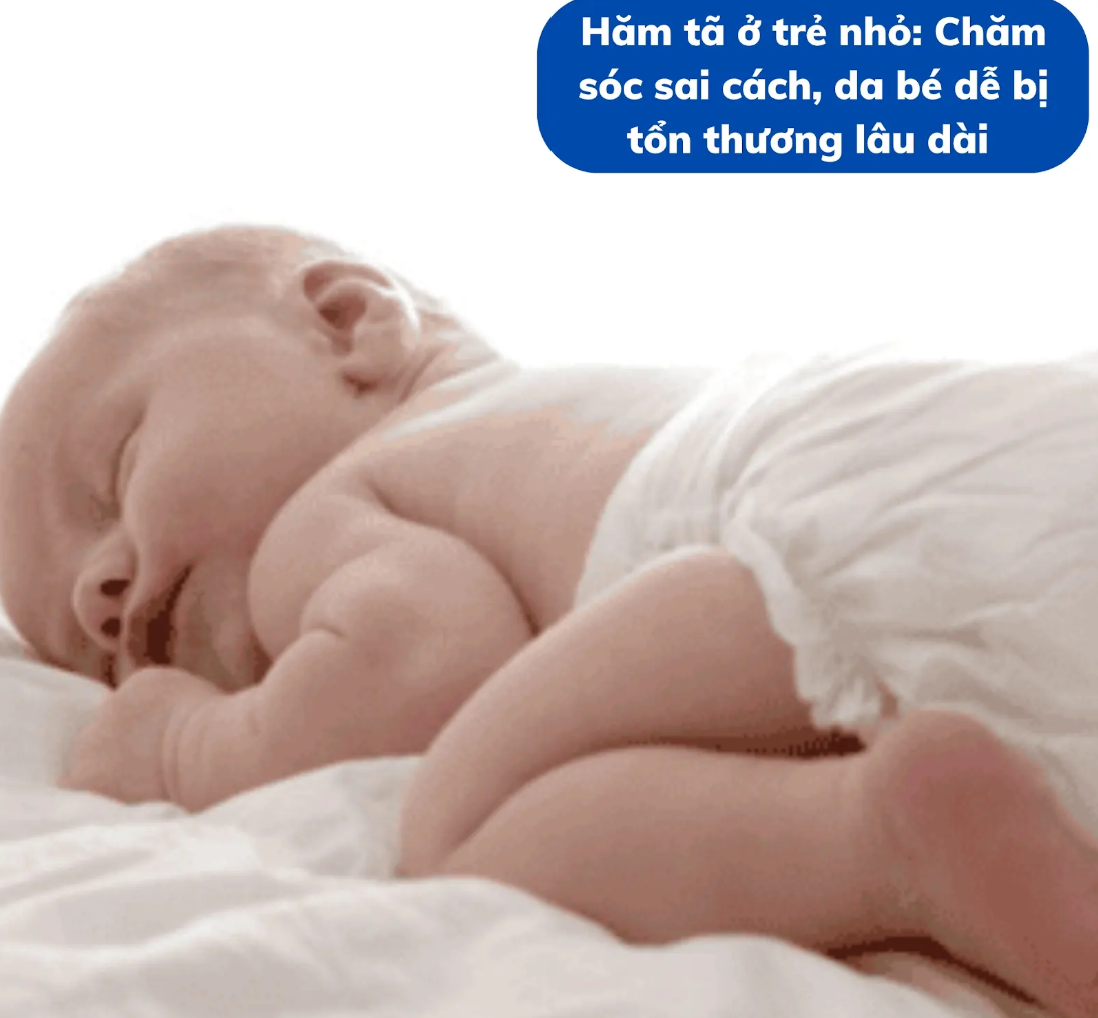 Hăm tã ở trẻ nhỏ: Chăm sóc sai cách, da bé dễ bị tổn thương lâu dài
