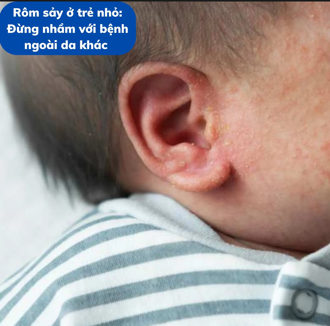 Rôm sảy ở trẻ nhỏ: Đừng nhầm với bệnh ngoài da khác 